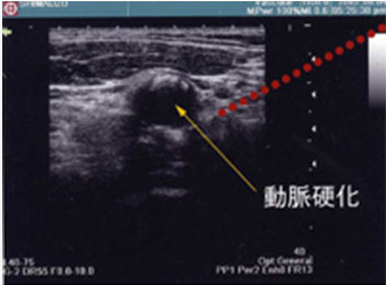 画像：頸動脈エコー